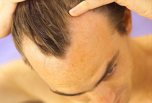 Quelles sont les causes de la perte de cheveux?