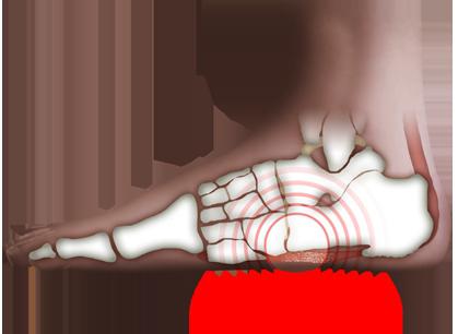 La gymnastique thérapeutique comme moyen de combattre les pieds plats