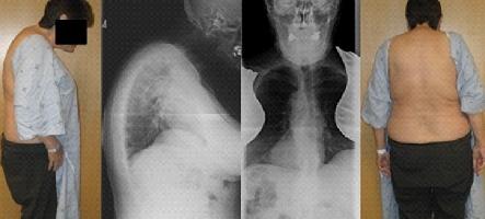 quelle est la spondylarthrite ankylosante