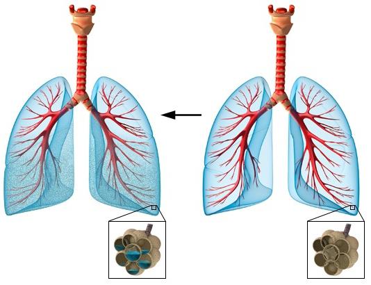 Œdème pulmonaire avec insuffisance cardiaque