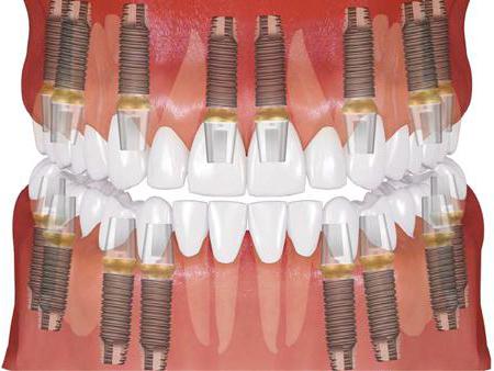 os de l'implant