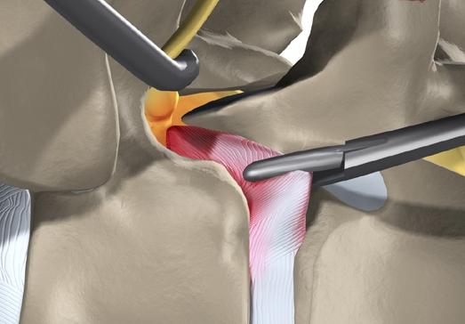 Comment est le traitement de la hernie intervertébrale?