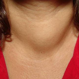 symptômes de cancer de la thyroïde commentaires