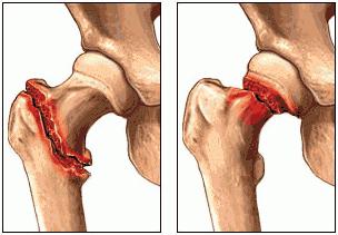 Fractures de la hanche: variétés, groupes à risque et autres
