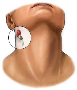 lymphonodus derrière les oreilles