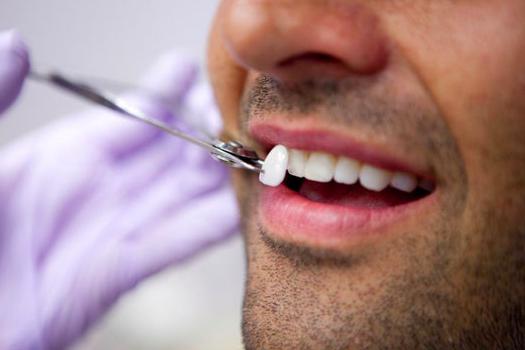 façons d'aligner les dents 