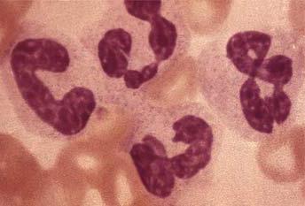 Les monocytes réduits sont des signes avant-coureurs de la maladie