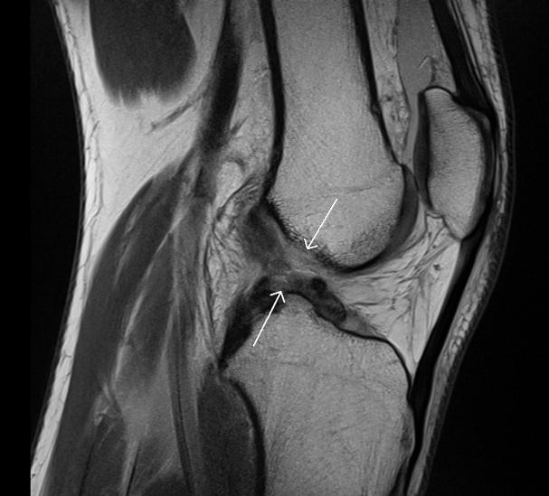 rupture du ligament croisé antérieur