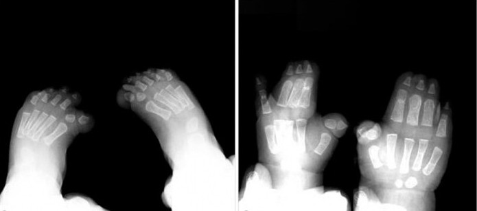 Syndrome de Pfayffer type 1 symptômes