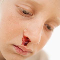 Le sang coule du nez, que dois-je faire? Raisons et solutions au problème