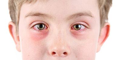 Tobrandex Gouttes pour les examens des yeux