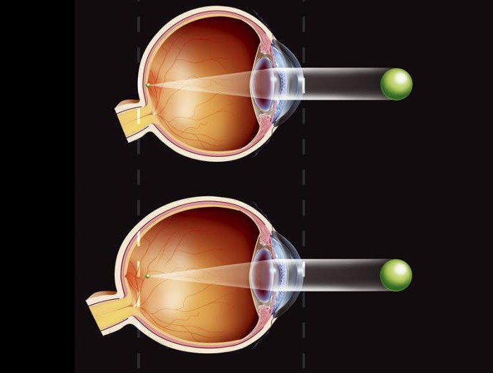 gouttes de vitamines pour les yeux qui sont meilleurs pour le glaucome